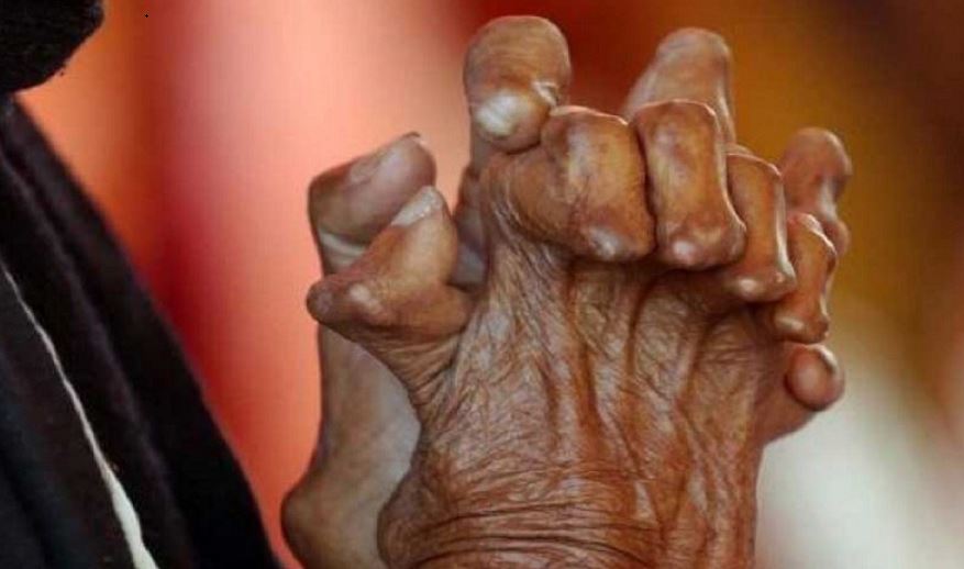 निवारणको घोषणा मात्रै, कुष्ठरोगीको संख्या झनझन बढ्दै  